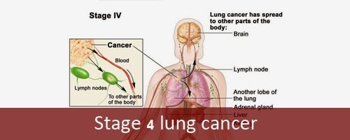 Stage 4 lung cancer