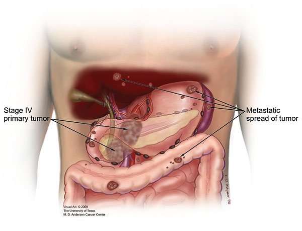 Stage IV Pancreatic Cancer