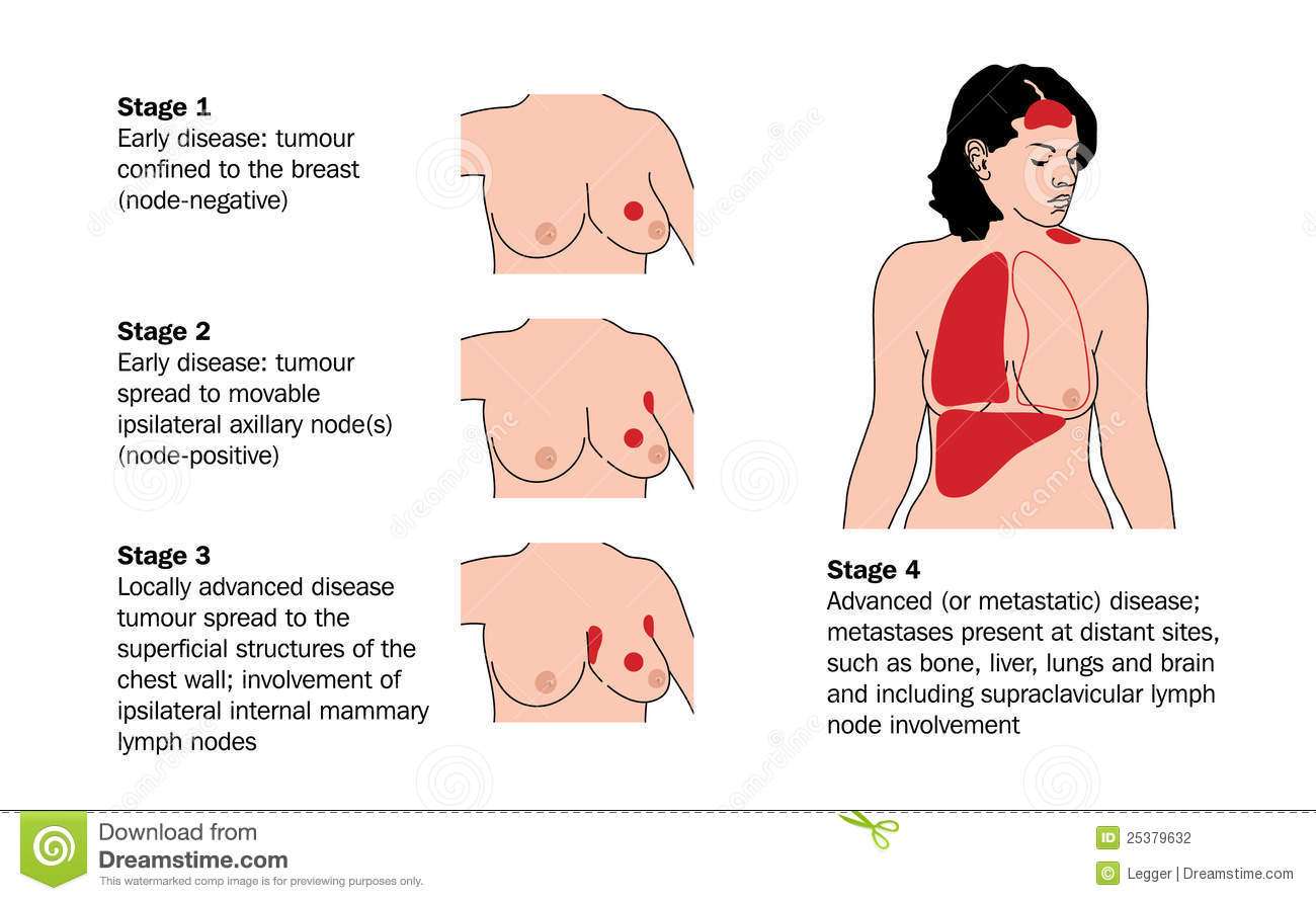 Stages Of Breast Cancer Vector Illustration