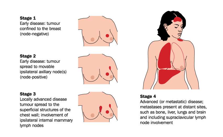 Surgery Improves Survival for Advanced Breast Cancer Patients ...