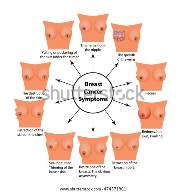 Symptoms Breast Cancer Infographics Vector Illustration Stock Vector ...