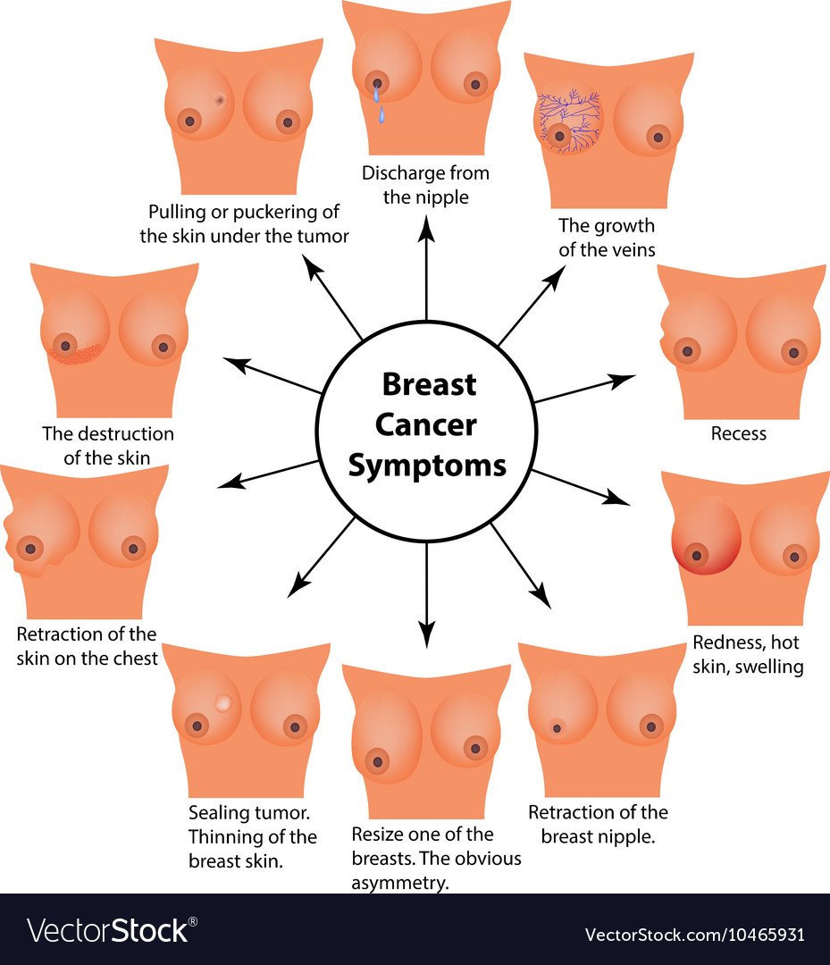 Symptoms of breast cancer Infographics Royalty Free Vector