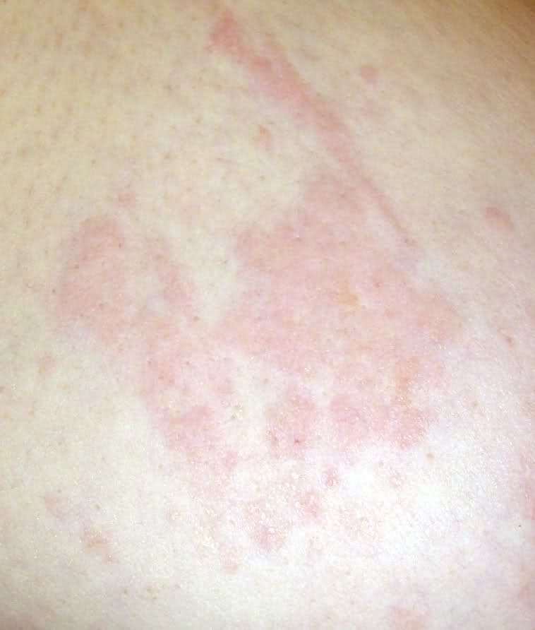 Eczema Type Rash On Breast Design Talk