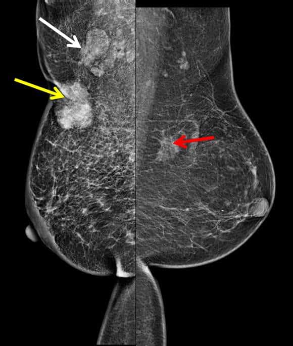 Synchronous breast cancer  Radiology Cases