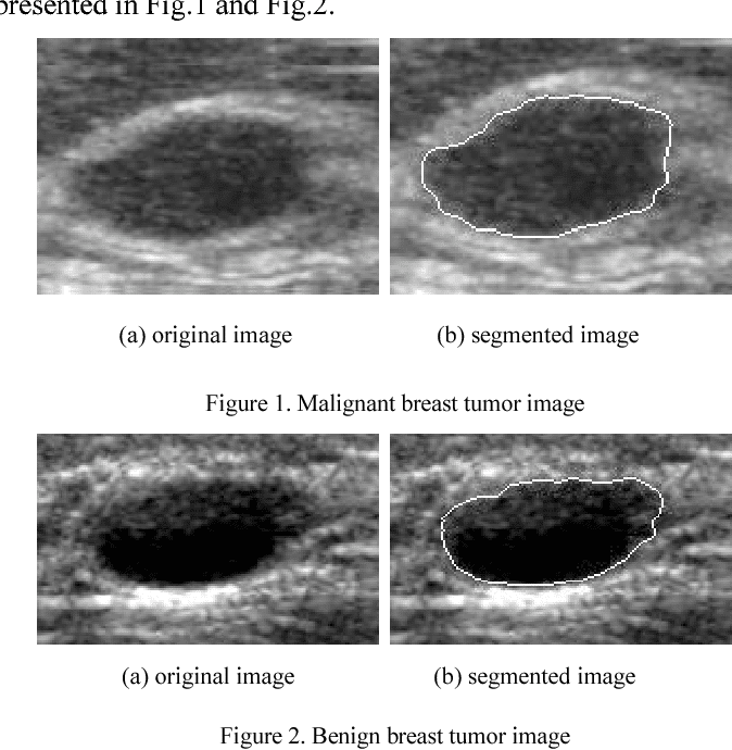 Textural Feature Analysis for Ultrasound Breast Tumor Images