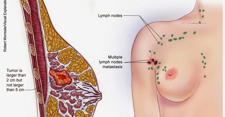 The 5 types of cancer most common in women ~ Health care ...