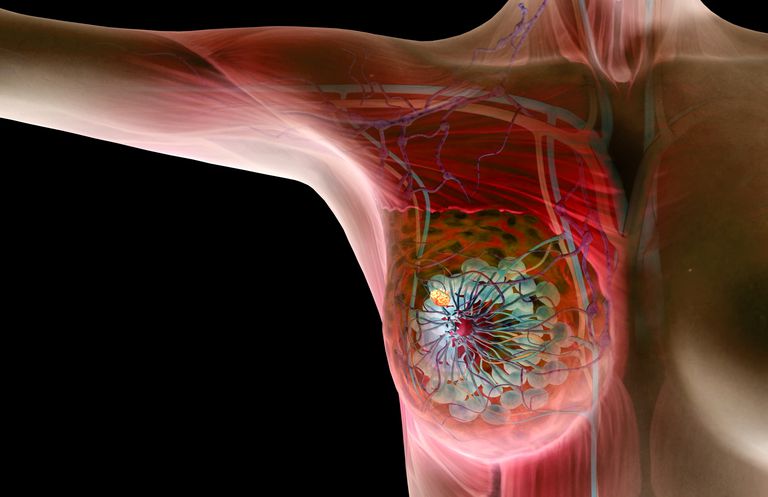The Basics on Benign and Cancerous Breast Lumps