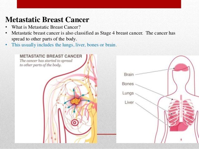the breast cancer and its different type ,stages and ...