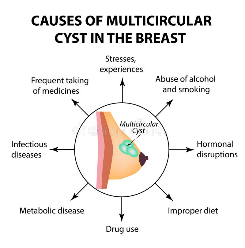 The Causes Of Multicameral Cyst. World Breast Cancer Day. Tumor. Vector ...