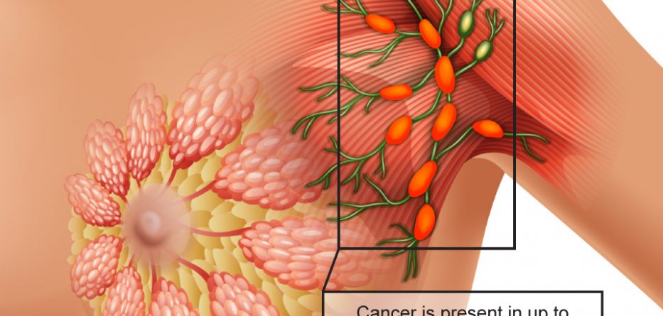 The Different Stages of Breast Cancer and what it ...