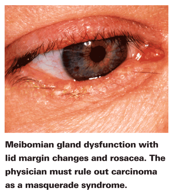 The Experts Open Up on Meibomian Dysfunction