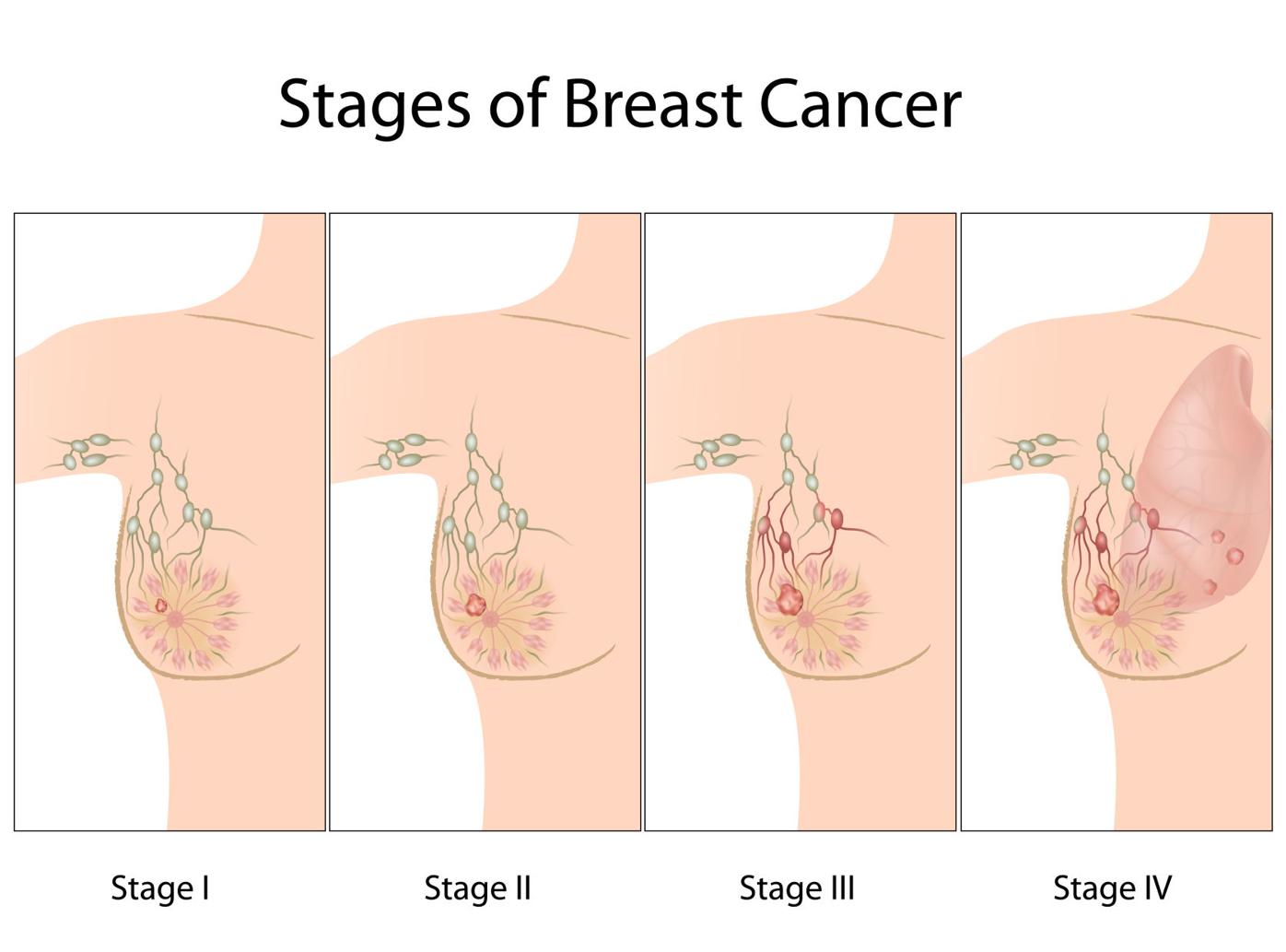 The stages of breast cancer