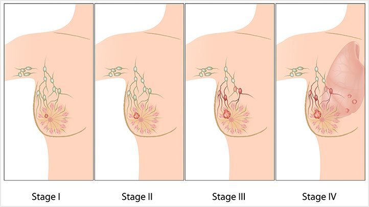 The Stages of Breast Cancer: What You Need to Know ...