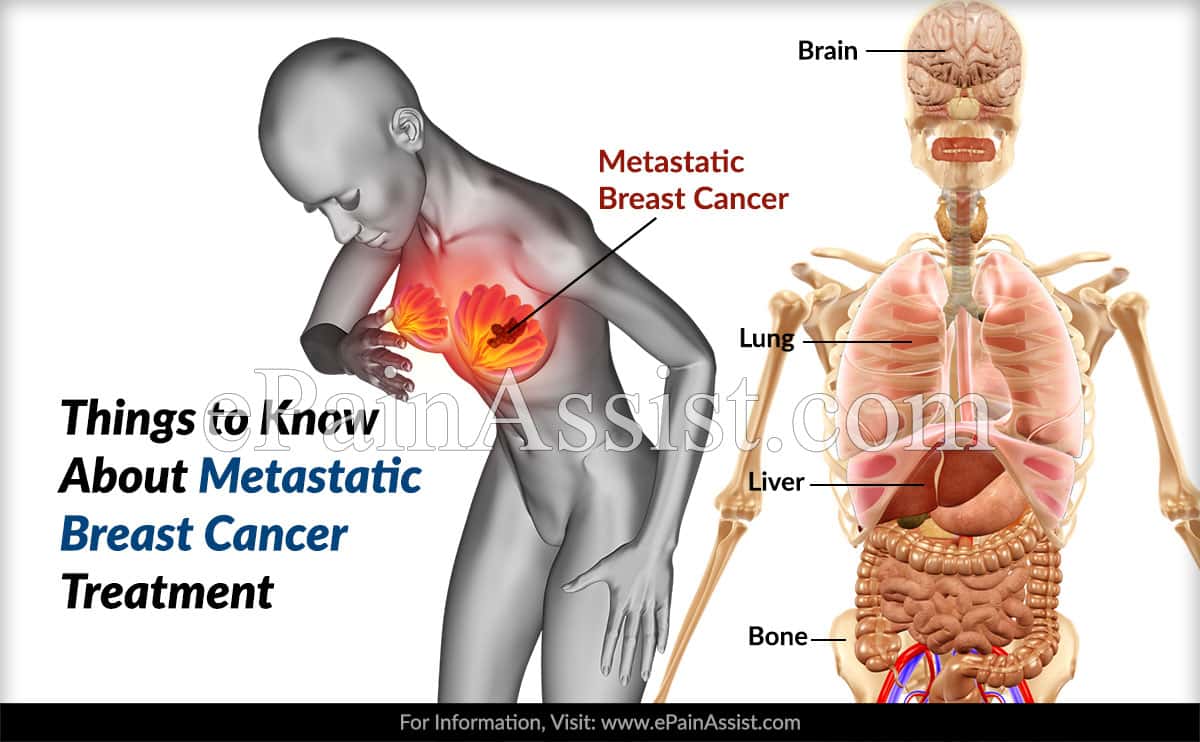 Things to Know About Metastatic Breast Cancer Treatment