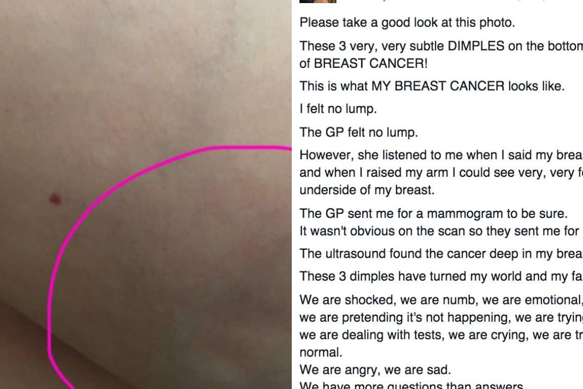 This woman posted a photo of her breast cancer as a warning for ...