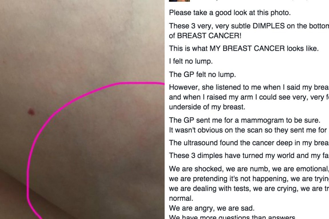 This woman posted a photo of her breast cancer as a ...