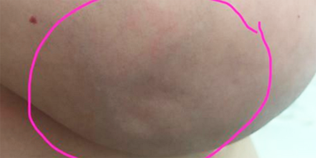 This Woman Shared A Picture Of Her Breast So You Can See ...