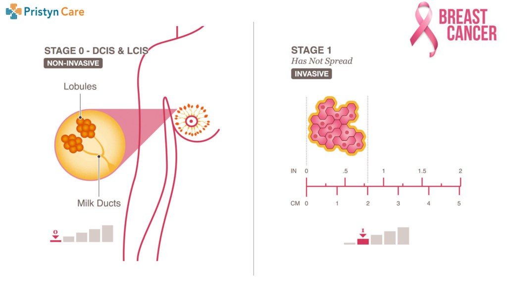 TNM Staging System for Breast Cancer