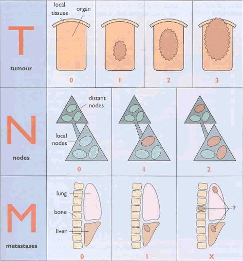 TNM tumour staging system