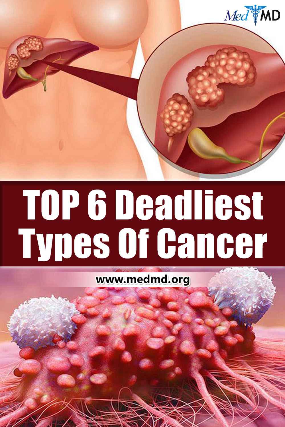 Top 6 Deadliest Types of Cancer
