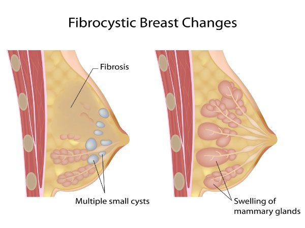 Treatment Options For Fibrocystic Breast Disease
