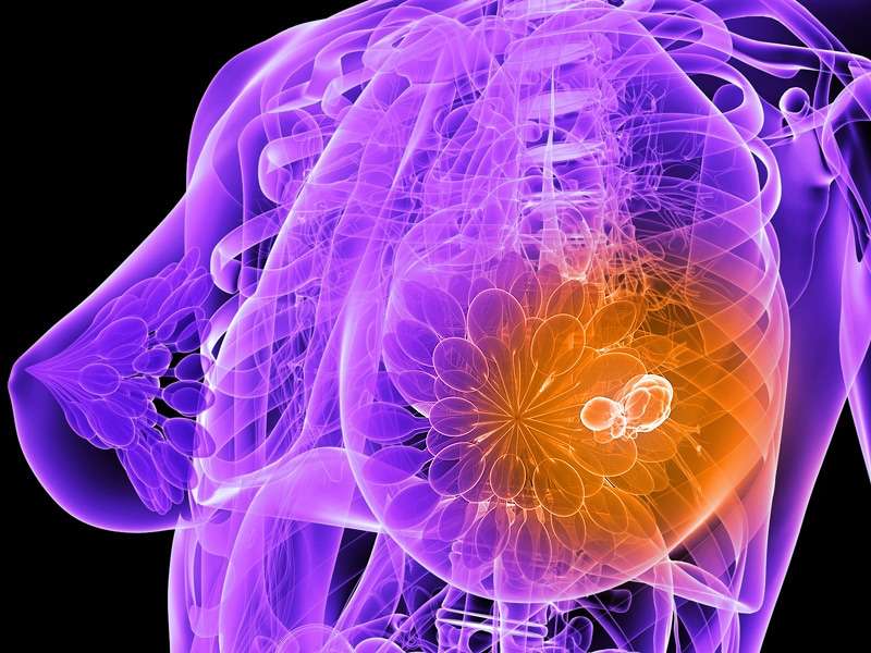 Tumor Stage Still Influences Survival in Breast Cancer