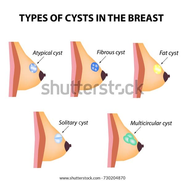 Types Cysts Breast Atypical Fibrous Fatty Stock Illustration 730204870