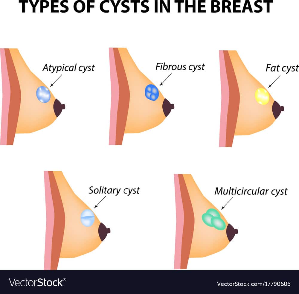 Types cysts breast atypical solid breast cancer Vector Image