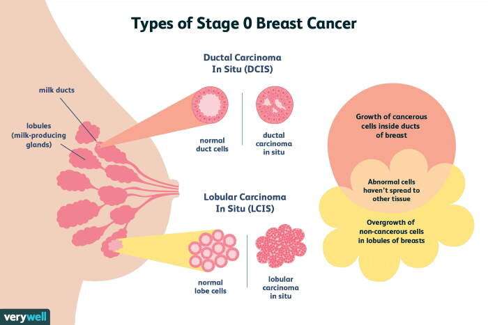 Types Of Breast Cancer Australia / Australian study claims some cancers ...