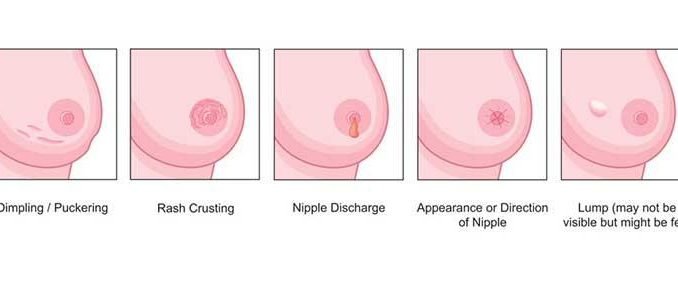 Understanding Symptoms &  Best Way To Beat Women Breast Cancer