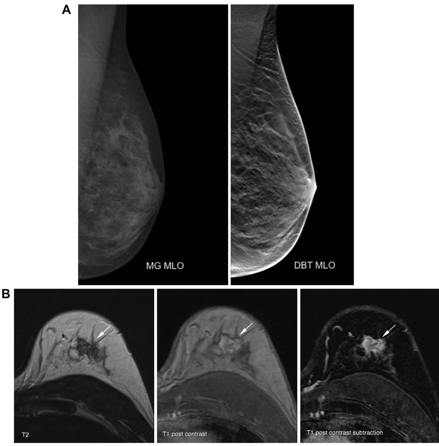 Value of Additional Digital Breast Tomosynthesis for Preoperative ...