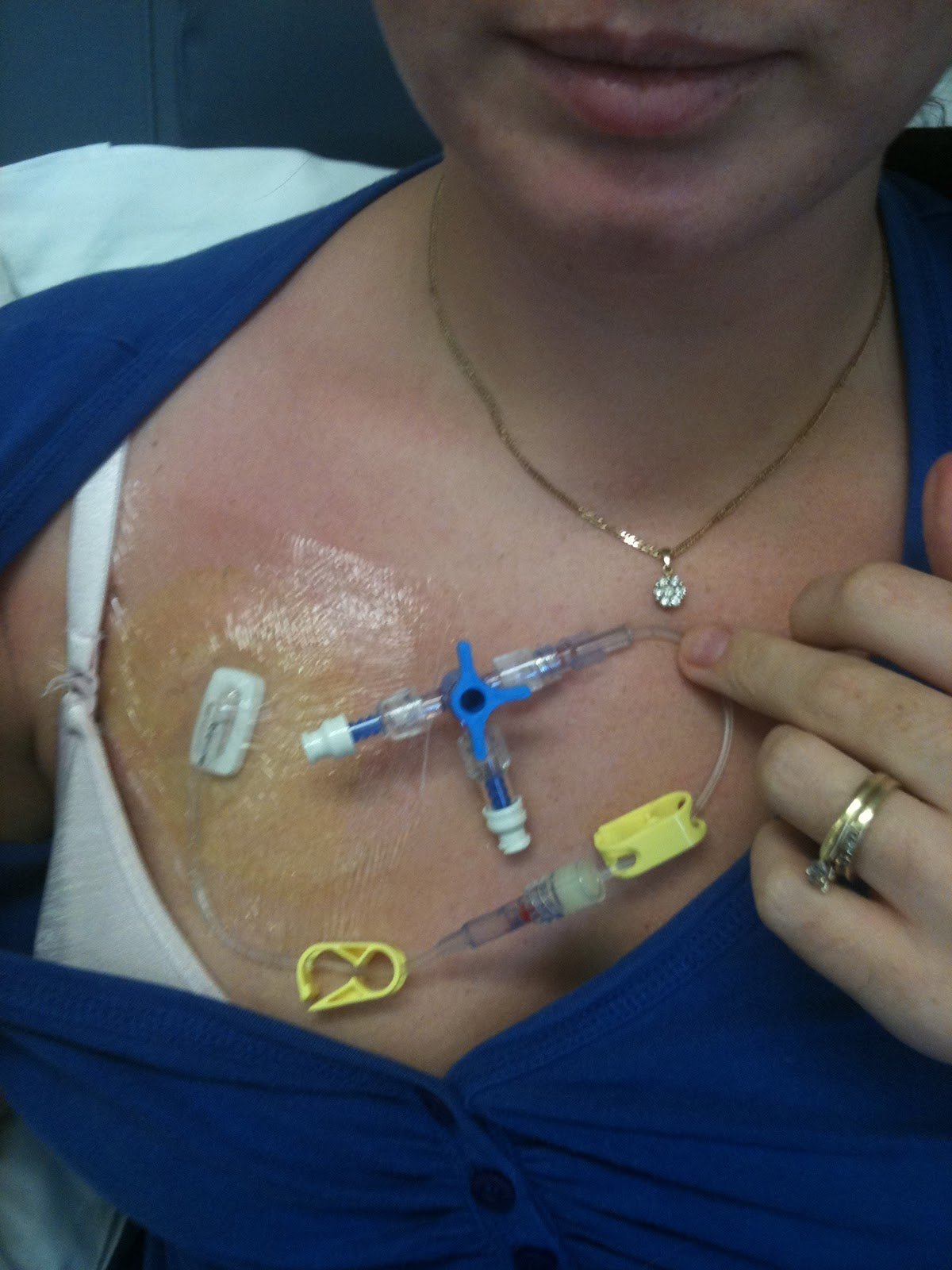 Vanquishing Triple Negative Breast Cancer My Way: Chemo ...