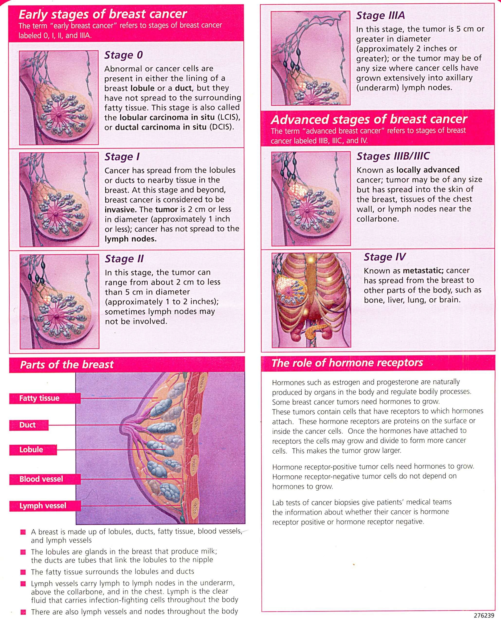 Visual Guide to The Stages of Breast Cancer