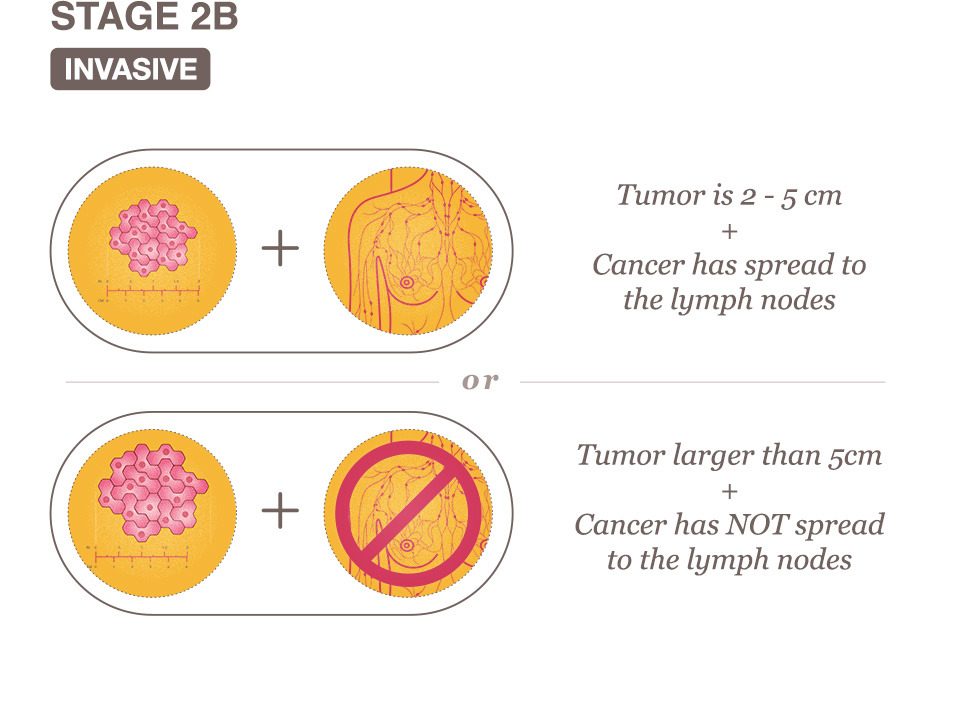 Welcome to GetPinkOn Blog: Breast Cancer Stages II, III and IV