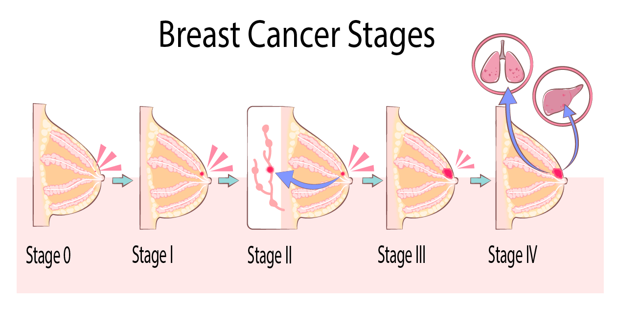 What Are My Surgery Options After Breast Cancer Treatment ...