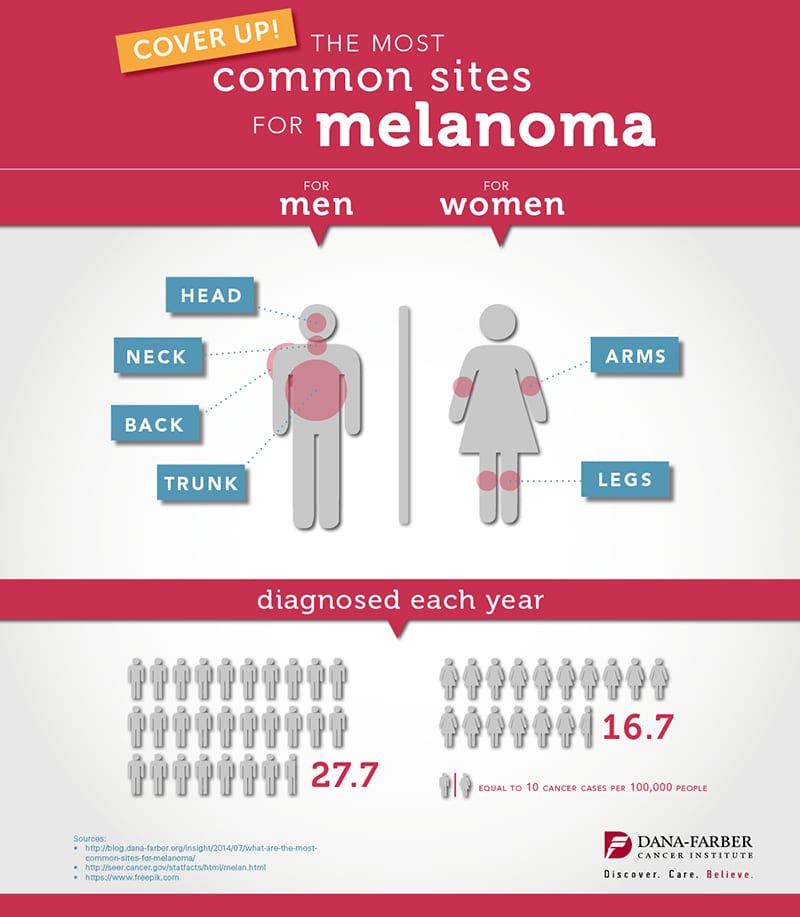 What are the Most Common Sites for Melanoma? [Infographic]