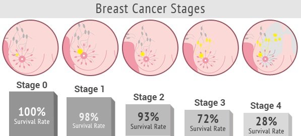 What are the stages of breast cancer?