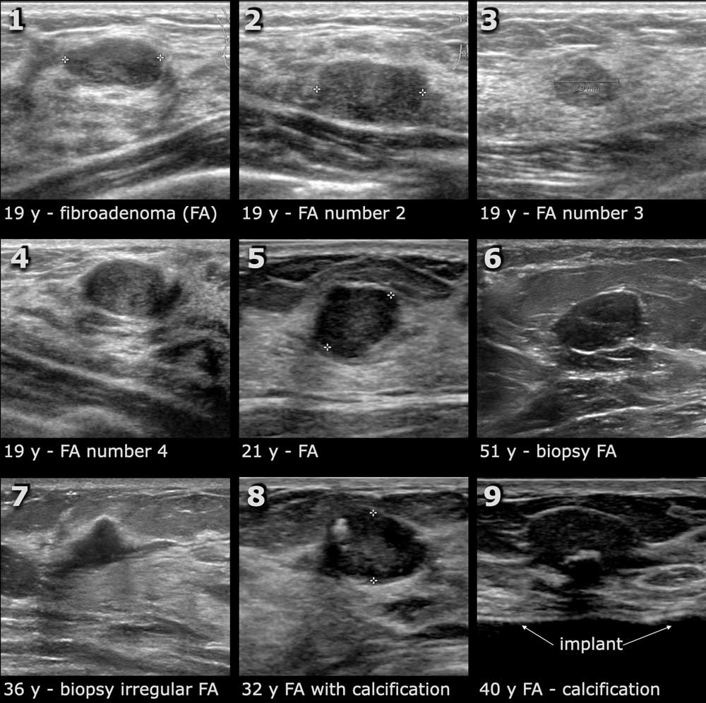 What Does Breast Cancer Look Like On Ultrasound Images