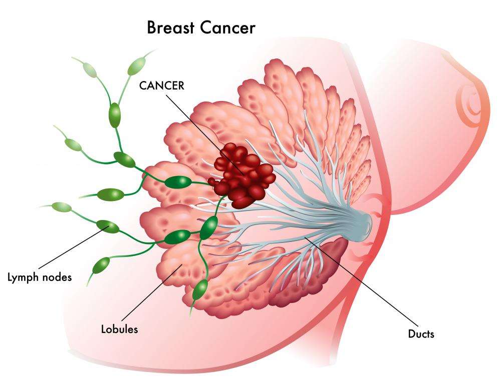 What Does Breast Cancer Lump Feel Like