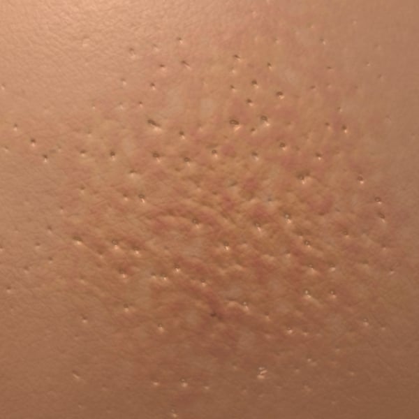 What Does Breast Cancer Orange Peel Skin Look Like
