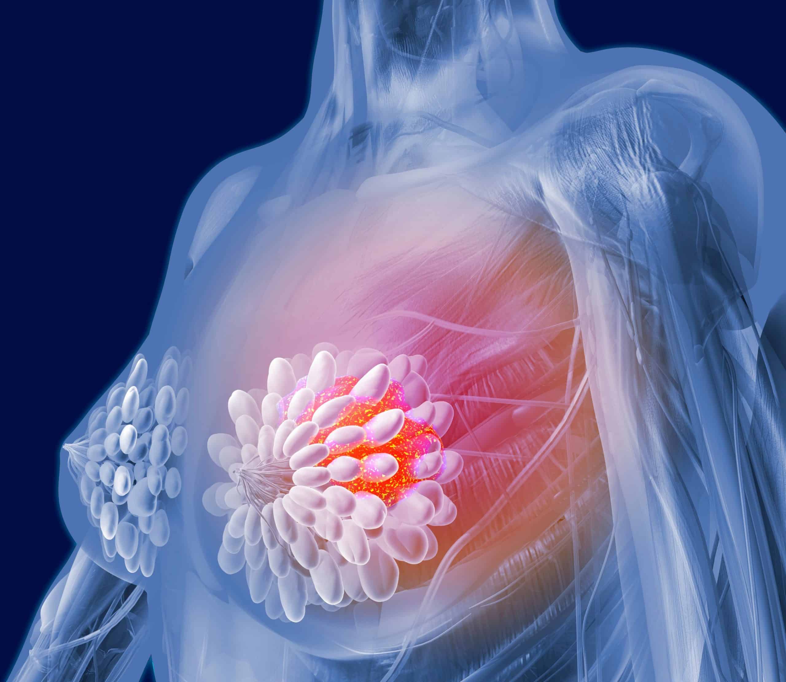 What does lump feel like in breast cancer ? Updated Guide 2022