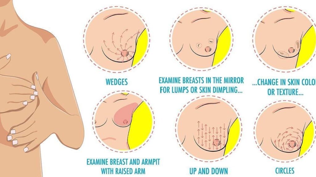 What Does Skin Dimpling Look Like In Breast Cancer ...