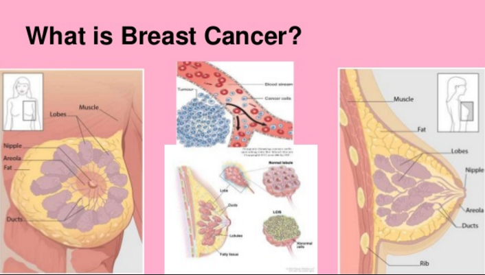 What Is Breast Cancer and How It Spreads?