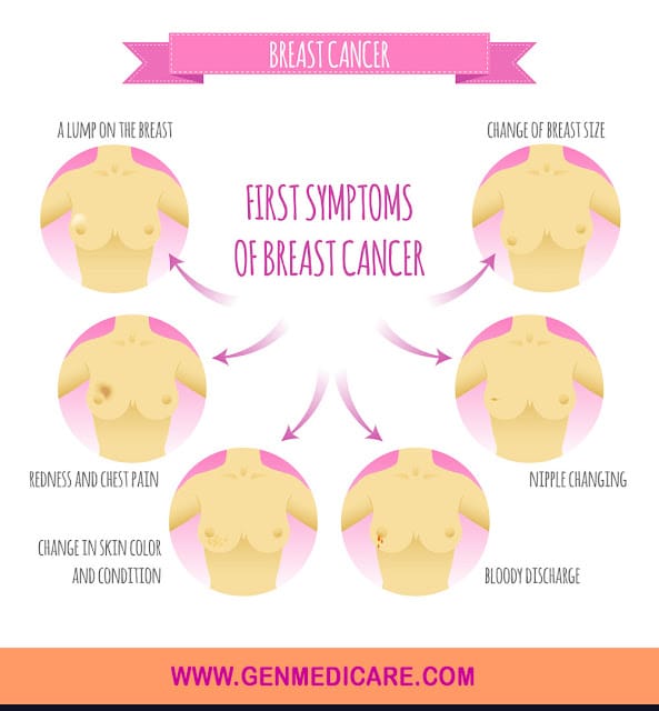 What is breast cancer? Know Breast Cancer Treatment, Signs, Causes at ...