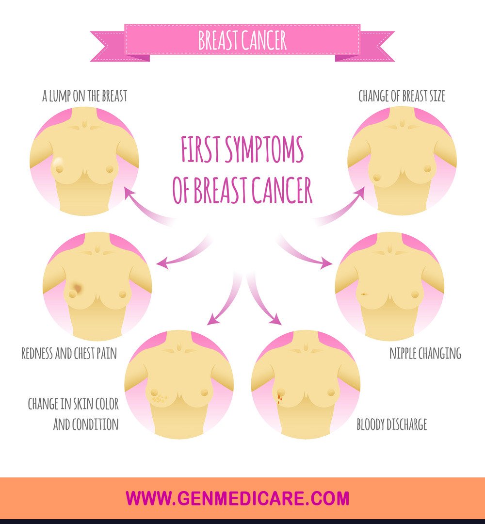 What is breast cancer? Know Breast Cancer Treatment, Signs ...