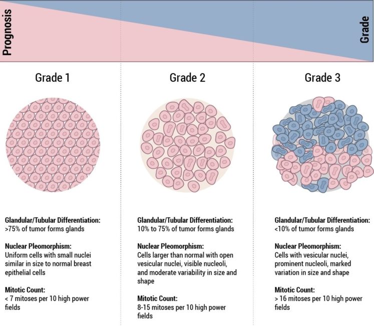 What Is Grade 1 Breast Cancer