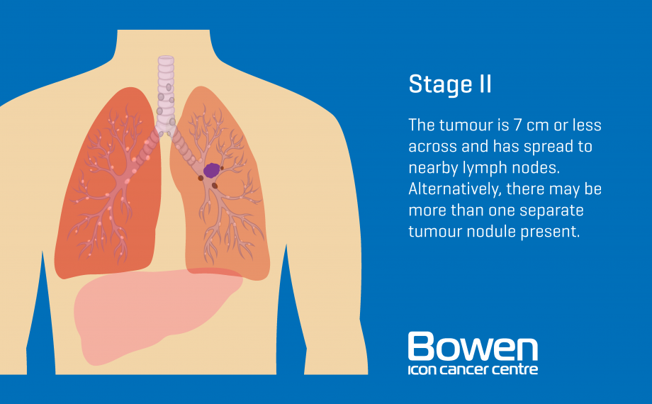 What is Lung Cancer? Lung Cancer Explained â Bowen Icon ...