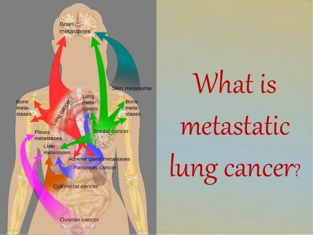 What is metastatic lung cancer?