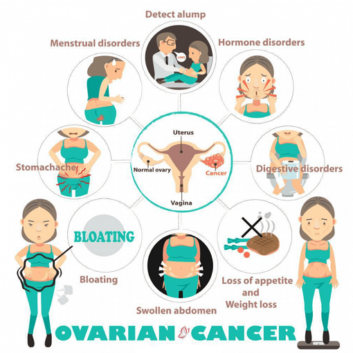 What is ovarian cancer? Causes, signs, treatment of ...