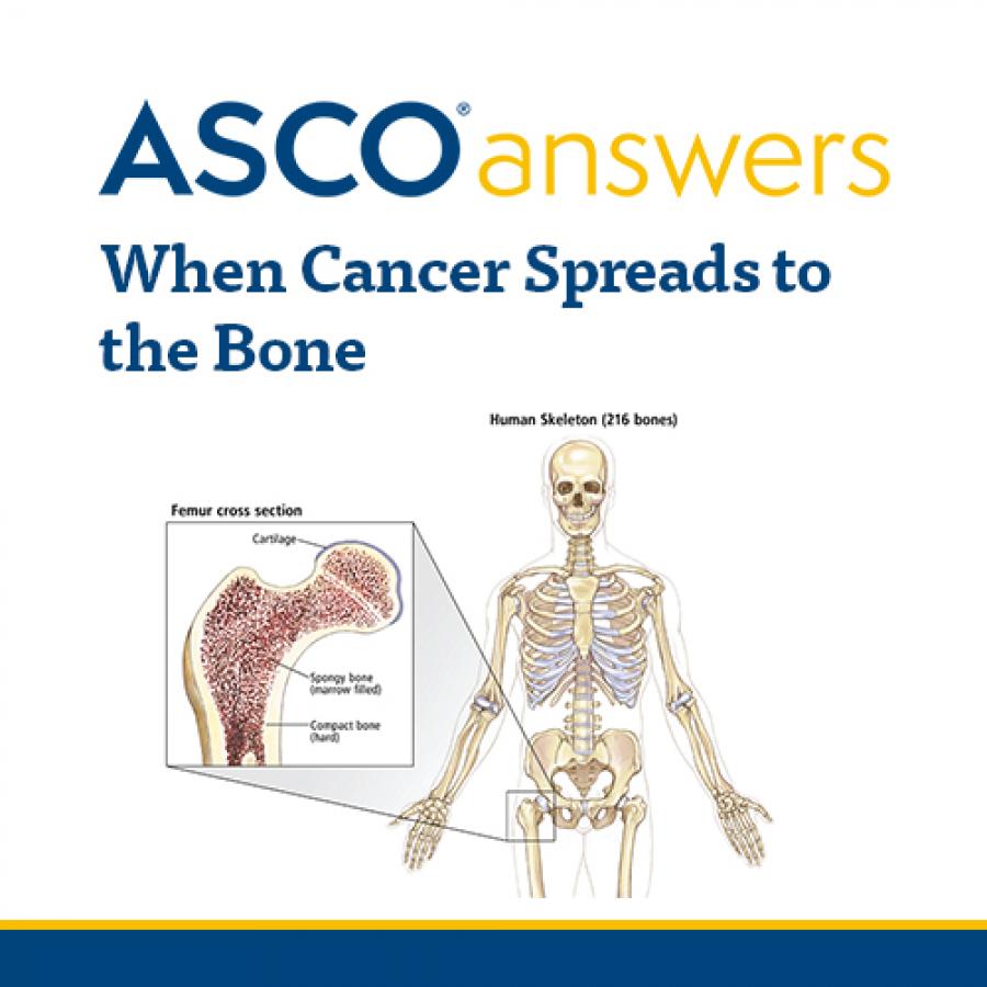 When Cancer Spreads to the Bone (Pack of 50 Sheets): ASCO Store